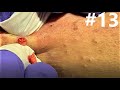 Blackheads extractions on happy 13