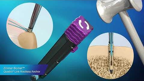 Quattro Link Knotless Anchor. ZimmerBiomet