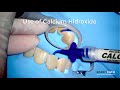 Easy use of calcium hydroxide in endodontics