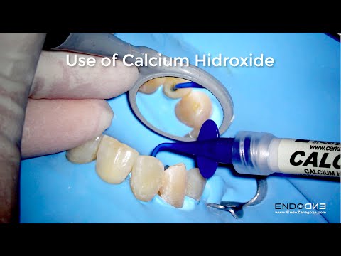 Video Easy use of Calcium Hydroxide in endodontics - youtube