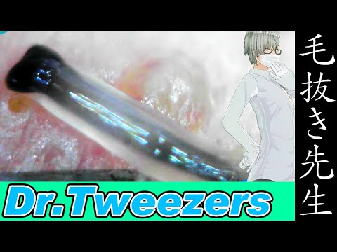 363 [200x Zoom] ヒゲ Dr. tweezers 毛抜き先生の角栓や毛根