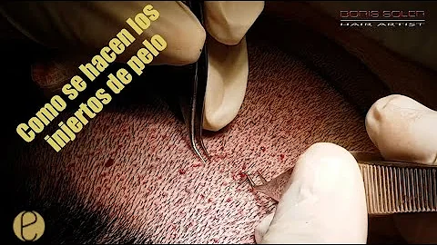 O que faz o folículo romper?