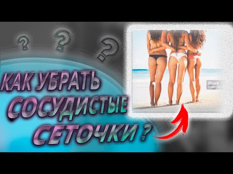Как избавиться от сосудистых звездочек и варикоза без операции и подготовить свои ноги к лету