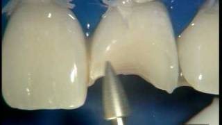ceram-x-duo-IV-part1.mpg