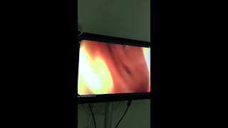 Download Kolonoskopi, Diverticulosis Coli Bağırsağın Divertiküler Hastalığı Video MP3 Kolonoskopi, Diverticulosis Coli Bağırsağın Divertiküler Hastalığı