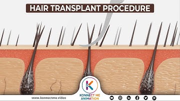 Hair Transplant Procedure | 3D Animation | By Konnect Me Animation