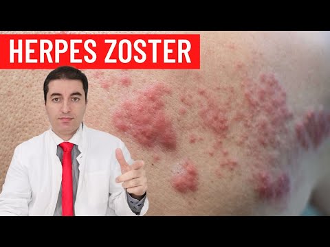 Video: Zašto je herpes zoster jednostran?