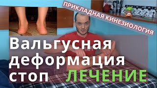 Лечение плоскостопия и вальгуса стоп. Прикладная кинезиология и остеопатия