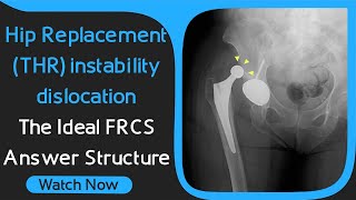 Hip Replacement (THR) instability/dislocation - The Ideal FRCS Answer Structure