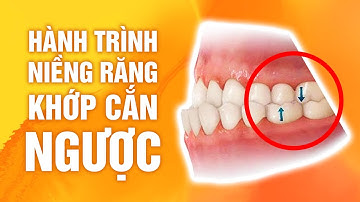 Hành Trình Niềng Răng Cải Thiện Khớp Cắn Ngược - Nha Khoa Hoàn Mỹ