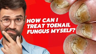 HOW CAN I TREAT TOENAIL FUNGUS MYSELF?