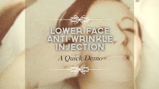 Lower face antiwrinkle injections Melbourne