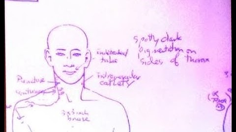 MICHAEL JACKSON: Pt 84 "The autopsy photo" (WARNING graphic!) (What DID happen on June 25th?)