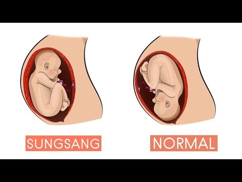 Posisi Bayi Sungsang ? Begini Cara Mengubah Posisi Bayi Sungsang Menjadi Normal !