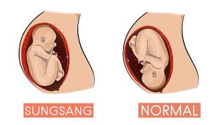 Posisi Bayi Sungsang ? Begini Cara Mengubah Posisi Bayi Sungsang Menjadi Normal !