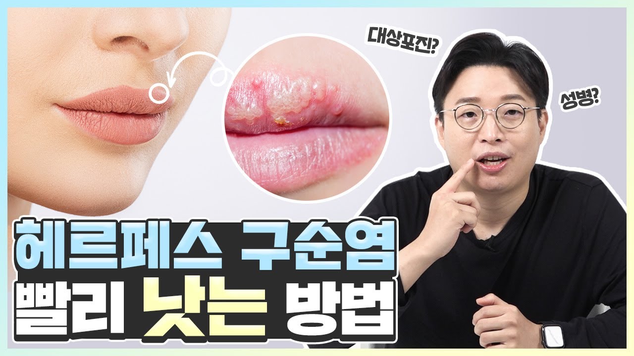 구강 헤르페스는 1형 또는 2형 성병입니까? (증상, 재발, 원인, 치료) 10