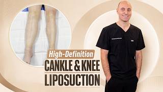 Lipedema Lipo Reveal 😍 360° Cankle &amp; Knee | Dr. George Kardashian | She Finally Saw Her Knees Again!