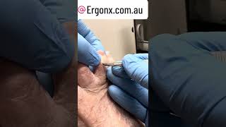 Mucous Cyst Draining In The Podiatry Clinic