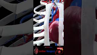 Open Heart 🔪 Cardiac Surgery ╭❤️～ Heart Bypass || 3D Medical Animation