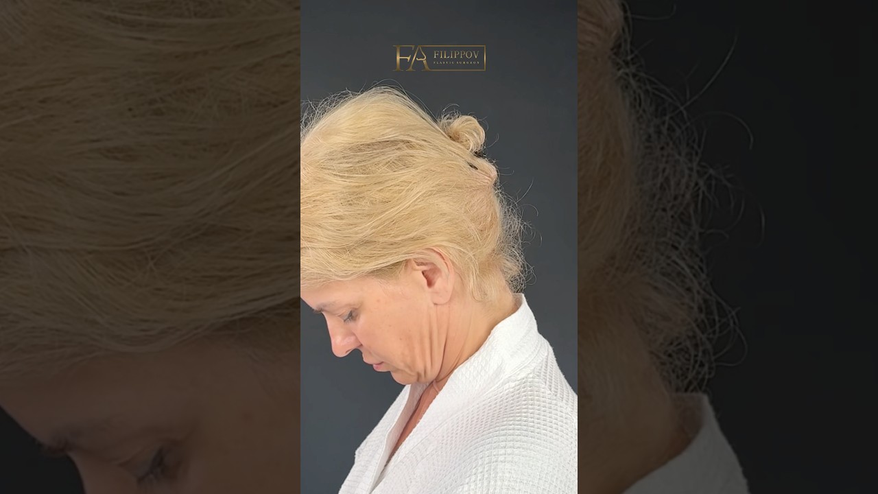 2 Недели после подтяжки. Фейслифтинг. Доктор ФИЛИППОВ