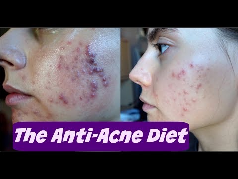 GETTING RID OF ACNE THROUGH DIET ||  (Anti-Acne Diet)  ACNE FREE IN ONE WEEK EXPERIMENT