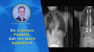 Do SCOLIOSIS Patients Get TOO MUCH Radiation??