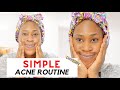 Simple 3 Step Skincare Routine For Mild - Moderate Acne  | Featuring Differin Products