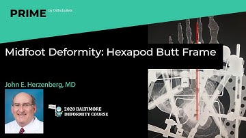 Midfoot Deformity: Hexapod Butt Frame - John E. Herzenberg, MD