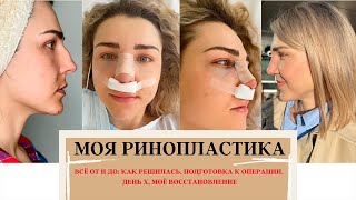 😱Я ЭТО СДЕЛАЛА😱 МОЯ РИНОПЛАСТИКА В ИСПАНИИ, ПАЛАТА, УСЛОВИЯ, ДЕПРЕССИЯ , ВОССТАНОВЛЕНИЕ, ДЕПРЕССИЯ