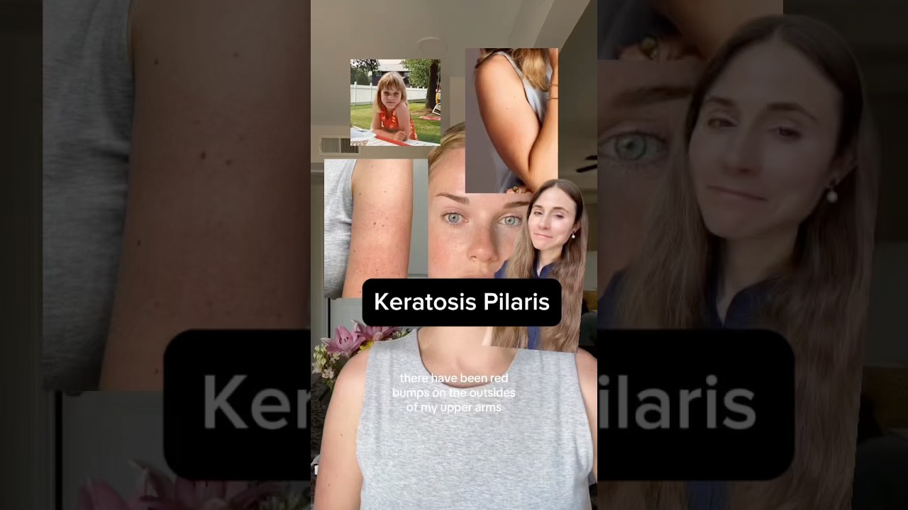 Say Goodbye to Chicken Skin - Complete KP Solution