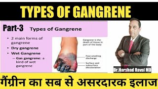 गैंग्रीन का सबसे असरकारक उपचार l Gangrene Treatment