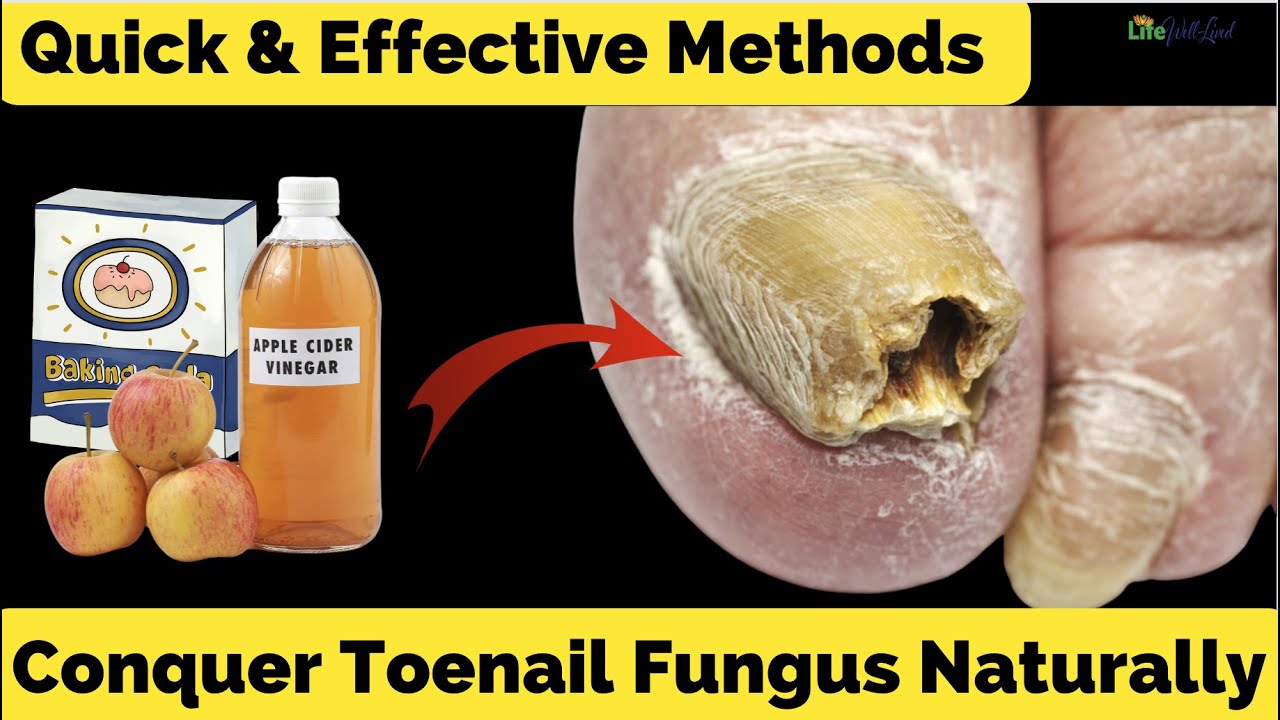 8 Quick and Effective Methods to Conquer Toenail Fungus Naturally YouTube