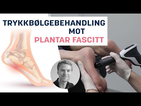 Effektiv Trykkbølgebehandling mot Plantar Fascitt