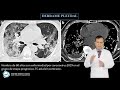 Uso de la Tomografía en enfermedad por el nuevo Coronavirus COVID-19