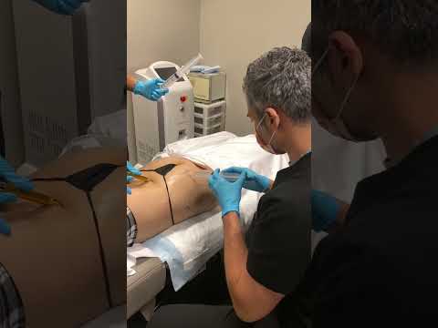 Monster Zombie BBL 20 Vials Of Sculptra 12 Syringes Of PRP Making This The Ultimate Bubble Butt