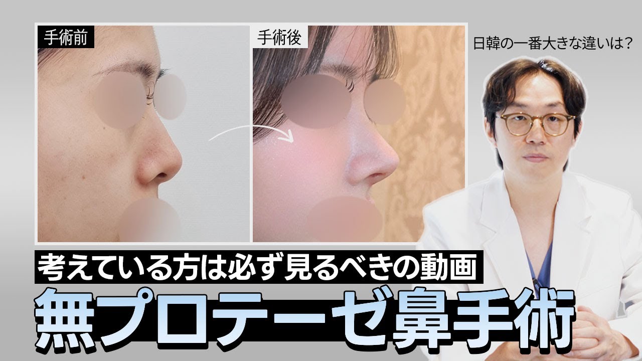 韓国の医師が日本語で説明する「無プロテーゼ鼻手術」が不可能な理由(🇯🇵日韓🇰🇷患者たちの無プロテーゼと自家肋軟骨使用に対する違いは?)