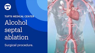 Alcohol Septal Ablation: Surgical Procedure for Hypertrophic Cardiomyopathy (HCM) | Tufts Medicine