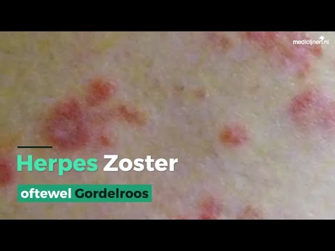 Video: Waarom is herpes zoster eenzijdig?