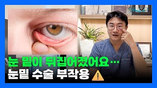 눈 밑이 뒤집어지는 부작용 ? 안검외반 복원수술로 회복하는 법💡