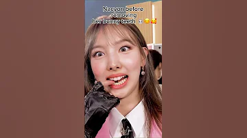 Naeyon Before VS After Removing Her Bunny Teeth Twice Bunnyteeth Love 