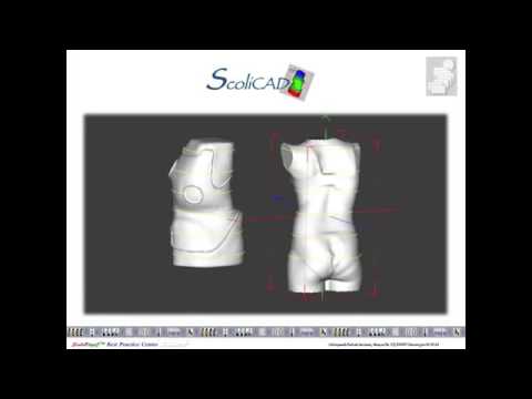 Gensingen Brace CAD / CAM (GBW) Production - YouTube