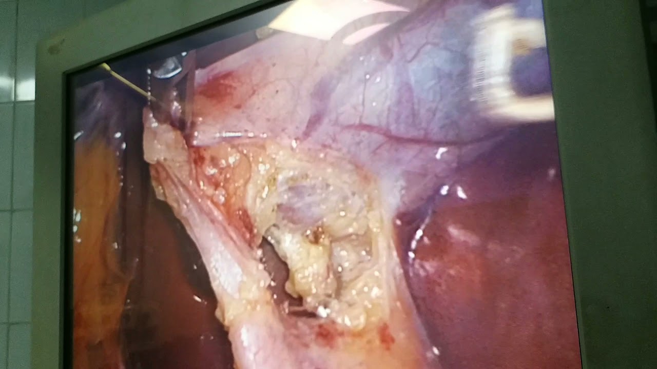 laparoscopic Cholecystectomy with hook dissection