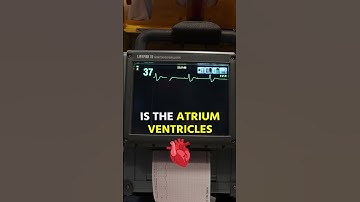COMPLETE Heart Block on EKG