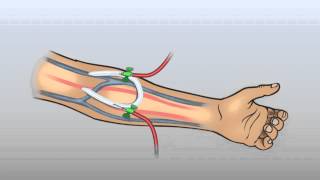 ARTERIOVENOUS GRAFT