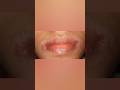 होंठ चाटने की बीमारी और उसका उपचार #drylips #dryskin #allergy #shortsfeed #shorts #ytshorts #viral