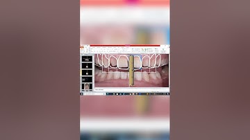 STEP BY STEP DSD on power point( digital smile design) @drahmedsamirr