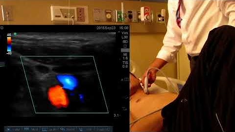 Angle dependence of Color Doppler