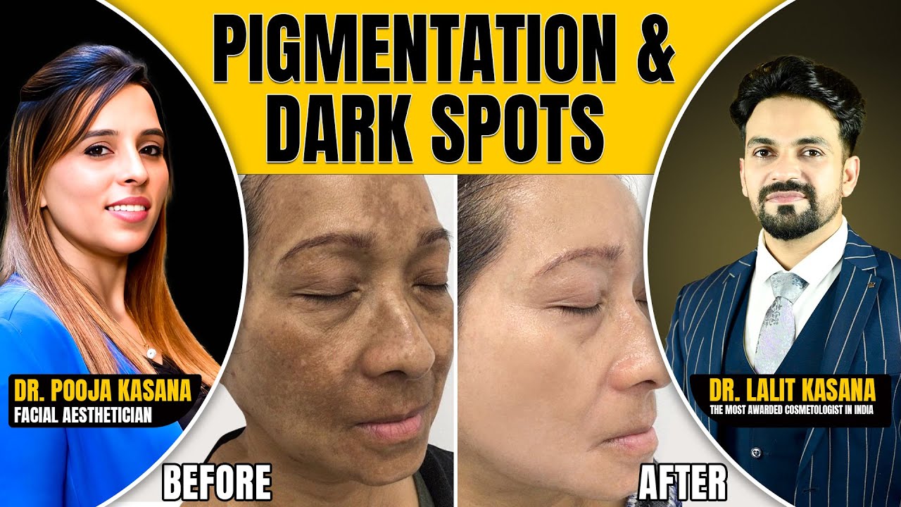 PIGMENTATION & DARK SPOTS | BEFORE & AFTER | DR. POOJA KASANA DR. LALIT KASANA