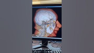 Ct scan video !! The Power of Toshiba Aquilion CX 128 Slice CT Scanner !#viral #highlights #trending