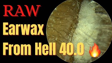 Earwax From Hell 40.0 Raw Footage 🔥